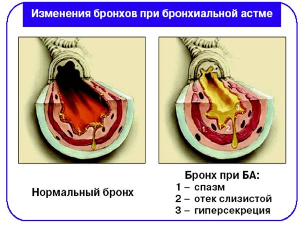 Вирусные заболевания при астме